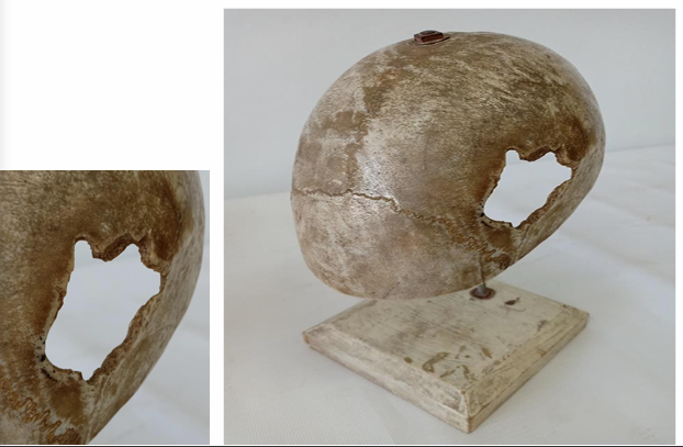<p>Questions</p><ol><li><p>What is the specimen being examined?</p></li><li><p>What are the type, specific descriptive features, and dimensions of the surgical intervention on the skull?</p></li><li><p>What specific tools and techniques are evidenced by the features of the gap?</p></li><li><p>How is the time of death estimated?</p></li><li><p>What are the possible causes of death?</p></li><li><p>What is the final diagnosis for this specimen?</p></li></ol><div data-type="horizontalRule"><hr></div><p></p>