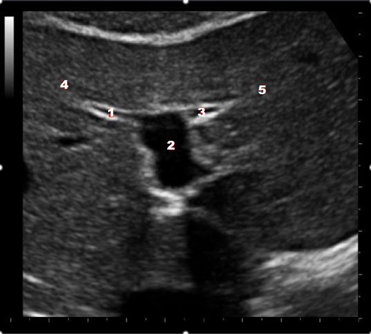 <p>What structure/vessel is indicated by #2?</p>
