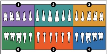 <p>When dentition is divided into six areas </p>