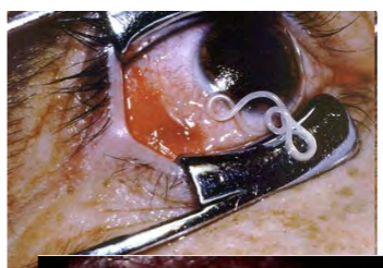 <p>endoparasite in phylum Nematoda</p><p>causes filariasis in eye</p><p>~12-13 million humans infected with larvae</p><p>human form is restricted to the rainforest and swamp forest areas of West Africa</p><p>contracted through biting insects (deer fly, mango fly)</p>