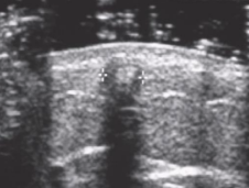 <ul><li><p><span style="background-color: transparent;">Foreign body present > 10 days</span></p></li><li><p><span style="background-color: transparent;">Dense granular material develops around FB</span></p></li><li><p><span style="background-color: transparent;">Inflammatory response → clean shadowing similar to bone</span></p></li></ul><p></p>