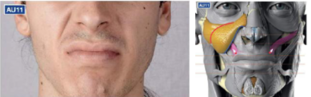 <ul><li><p>nasolabial deepener </p></li><li><p>creates a furrow above the upper lip</p></li></ul><p></p>
