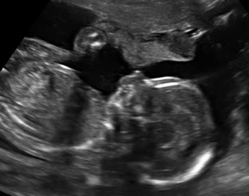 <p>small receding chin and lower lip </p><ul><li><p>associated with tri 18 </p></li></ul><p></p>