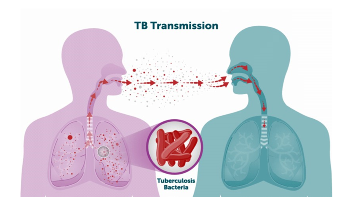 <p>A bacterial infection that mainly affects the lungs and spreads through the air when an infected person coughs or sneezes.</p>