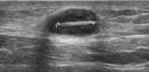 <ul><li><p>Foreign body present 3 - 10 days</p></li><li><p><span style="background-color: transparent;">Fluid replaces air</span></p></li><li><p><span style="background-color: transparent;">Most pronounced hypoechoic halo</span></p></li></ul><p></p>