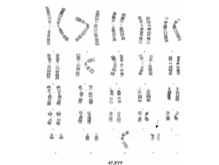 <ul><li><p>Genotype: XYY</p></li><li><p>Phenotypically male</p></li><li><p>1 in 1000 male births</p></li><li><p>XYY males are taller than average</p></li></ul><p></p>