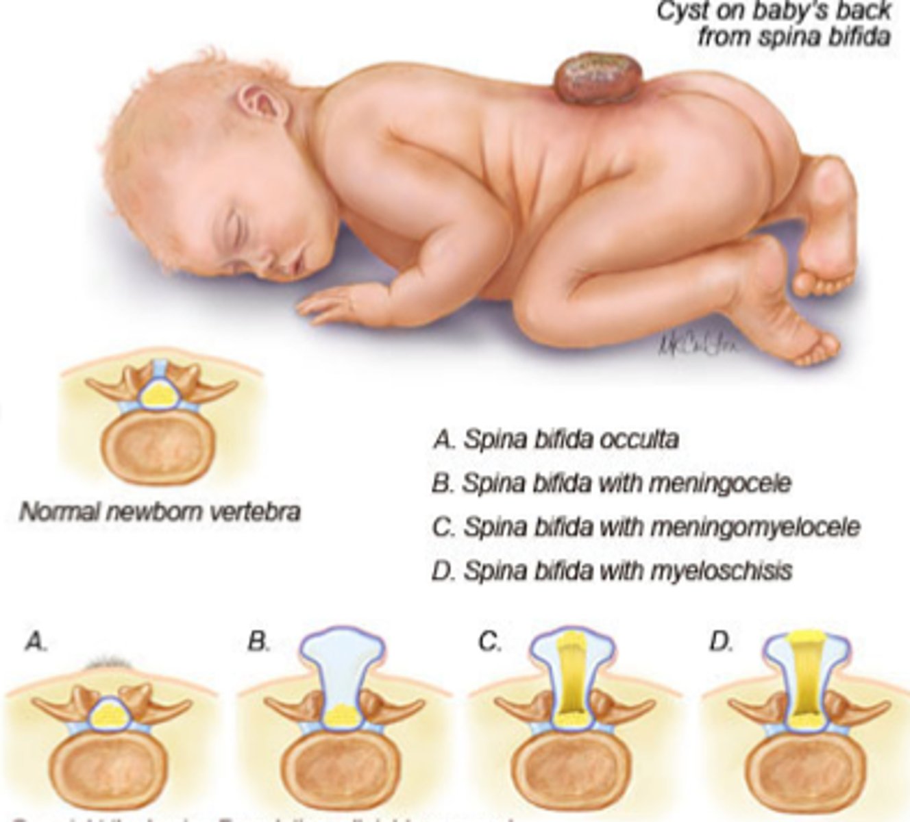 <p>parts of the spinal cord protrude from the spine causing possible paralysis and incontinence</p>