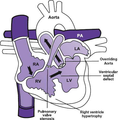 <p>Overriding aortic root</p><p>VSD</p><p>Pulmonary stenosis</p><p>Right ventricular hypertrophy</p>