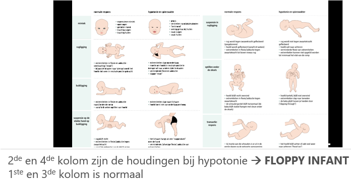 <p>Centrale hypotonie → Er is hier niet altijd duidelijke spierzwakte aanwezig. De hypotonie is vooral axiaal aanwezig en de peesreflexen zijn normaal. Bewegen tegen de zwaartekracht is wel lastig. Het heeft een centrale oorzaak (hersenen). Vaak zijn er bijkomende symptomen van een centraal cerebraal probleem (verlaagd bwz, epilepsie). Het komt o.a. voor bij trisomie 21 en Prader-Willi.</p><p>Perifere hypotonie/ spierzwakte → Spierzwakte staat op de voorgrond, bewegen tegen de zwaartekracht is amper mogelijk en de reflexen zijn laag of afwezig. Het heeft een perifere oorzaak (spieren/zenuwen) en komt voor bij kinderen met een neuromusculaire aandoening zoals Duchenne.</p>