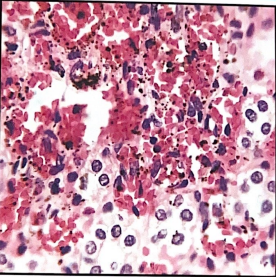 <p>The problem seen in this formalin-fixed tissue most likely will NOT occur if the: </p><p>a. tissue is washed after fixation </p><p>b. formalin pH is kept at neutrality </p><p>c. time of fixation is less than 12 hours </p><p>d. concentration of formalin is increased</p>