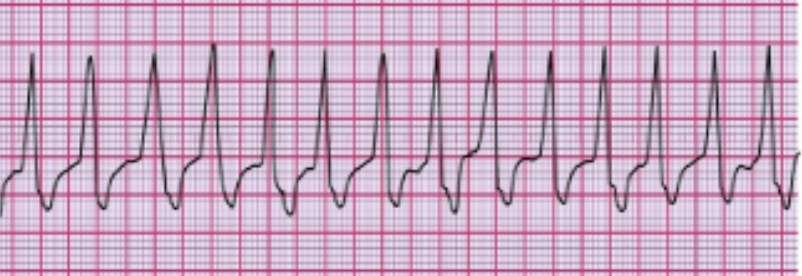 <p>What does this EKG indicate? </p>