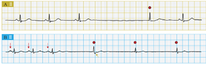 <p>Anytime the rate of the SA node is not adequate an area at the AV junction can pace the heart. heart beats 40-60bpm. The atria are depolarized through a process known as backward conduction, resulting in inverted P waves. Any “time” this happens to a QRS complex, they are escape “beats”</p>