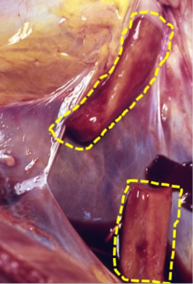 <p>Is this a post-mortem or ante-mortem clot?</p>