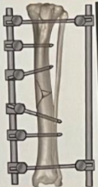 <p>Que tipo de fijación externa lineal es?</p>