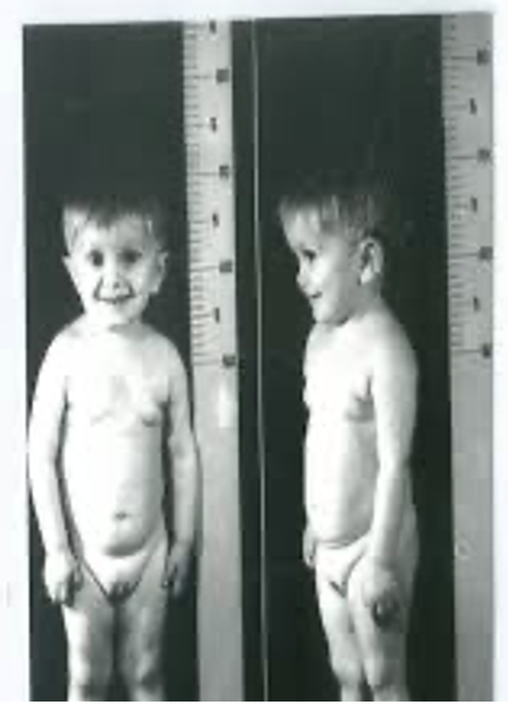 <p>deficient in what hormone</p>