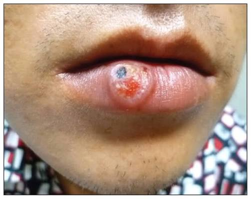 <p>What stage of syphilis is being described?</p><p>-Lasts 3-6 weeks</p><p>-Presentation: painless chancre at inoculation site, mild-moderate regional lymphadenopathy that is often bilateral </p>