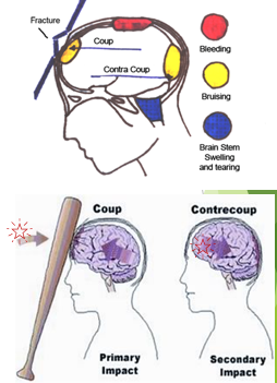 <p><span style="font-family: "Wingdings 3";">}</span><span style="font-family: "Trebuchet MS";">Any blow to the skull causes damage to the brain at the site of the impact – COUP injury…</span></p><p><span style="font-family: "Wingdings 3";">}</span><span style="font-family: "Trebuchet MS";">…as well as damage to the brain due to “rebound” when the brain secondarily impacts the opposite side of the skull (CONTRE-COUP injury).</span></p><p><span style="font-family: "Wingdings 3";">}</span><span style="font-family: "Trebuchet MS";">This phenomenon occurs when the force impacting the head is not only great enough to cause damage at the site of </span><span>impact, but</span><span style="font-family: "Trebuchet MS";"> also </span><span>is able to</span><span style="font-family: "Trebuchet MS";"> move the brain severely enough that damage occurs to the opposite side of the brain as well. </span></p>