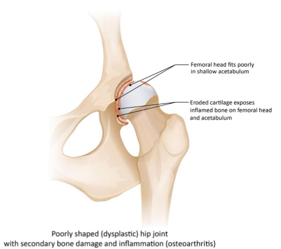 <p>Hip dysplasia diagnosis, management </p>