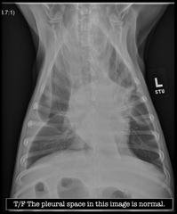 <p>TRUE OR FALSE: The pleural space in this image is normal.</p>