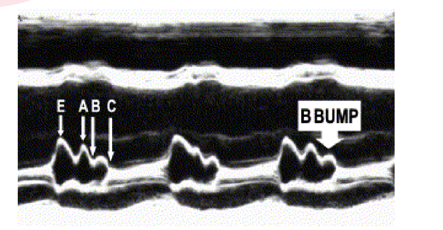 <p>what does this image tell you, why does in HCM? explain how it happens ?</p>