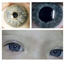 <p>What is the most likely diagnosis ?</p>