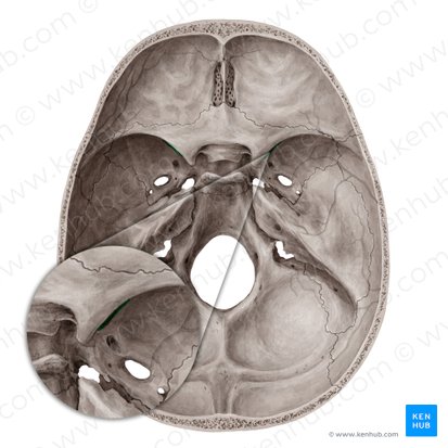 <p>Superior orbital fissure</p>
