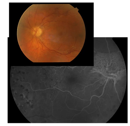 <ul><li><p>Clinical signs</p><ul><li><p>NVD, NVE, NVI</p></li><li><p>Fibrovascular tissue along the posterior surface of the vitreous</p></li><li><p>Fibrovascular tissue extending into the vitreous and adherent to the retina</p></li><li><p>Traction retinal detachment</p></li><li><p>Vitreous haemorrhage</p></li></ul></li><li><p>Fluorescein angiograpy</p><ul><li><p>Highlights the neovascularisation</p></li><li><p>Hyperfluorescence due to leakage from neovascular tissue</p></li></ul></li><li><p>Treatment</p><ul><li><p>PRP</p></li><li><p>Surgical treatment of retinal detachment</p></li><li><p>Pars plana vitrectomy in vitreous haemorrhage</p></li><li><p>Anti VEGF treatment with caution</p></li><li><p>Follow up every 4 weeks 7</p></li></ul></li></ul><p></p>