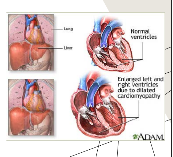 <p></p><p>AHA classification: Secondary •</p><p>Due to a systemic condition that involves the myocardium</p><p>• Toxicity •</p><p>May be reversible •</p><p>Consuming 6 drinks of alcohol per day > 5 days, risks developing asymptomatic DCM</p><p></p><p>Simple Way to Think About It Primary cardiomyopathy:</p><p>Problem starts mainly in the heart itself.</p><p>Secondary cardiomyopathy:</p><p>Something ELSE in the body damages the heart.</p><p>The heart problem is happening because of another disease or condition affecting the whole body.</p><p><strong>Systemic condition</strong> = a disease/problem affecting the body overall.<br><strong>Myocardium</strong> = heart muscle.</p><p>So:</p><p><strong>“Due to a systemic condition that involves the myocardium”</strong> means:<br>A body-wide condition is affecting/damaging the heart muscle, causing cardiomyopathy.</p>