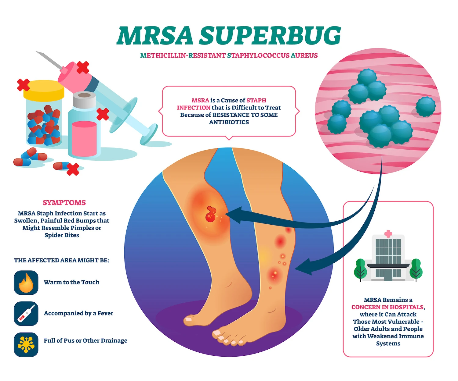 <p>Methicillin Resistant Staphylococcus Aureus; a staph infection resistant to typical antibiotics; systemic contraindication.</p>