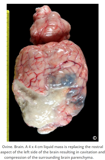 <p>Liquefactive necrosis is <strong>complete enzymatic digestion of dead tissue into a liquid mass.</strong></p><ul><li><p>Both tissue architecture and cellular detail are lost.</p></li></ul><p></p>