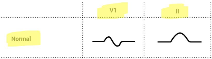 <p>What lead deflections are characteristic of RAH?</p>