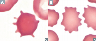 <p><strong><u>Acanthocytes </u></strong>= irregular projections of varying size and spacing; </p><p><strong><u>Echinocytes </u></strong>= smaller, more uniform, evenly spaced projections</p><p><br>(A = Acanthosis / B = Echinocytes)</p>