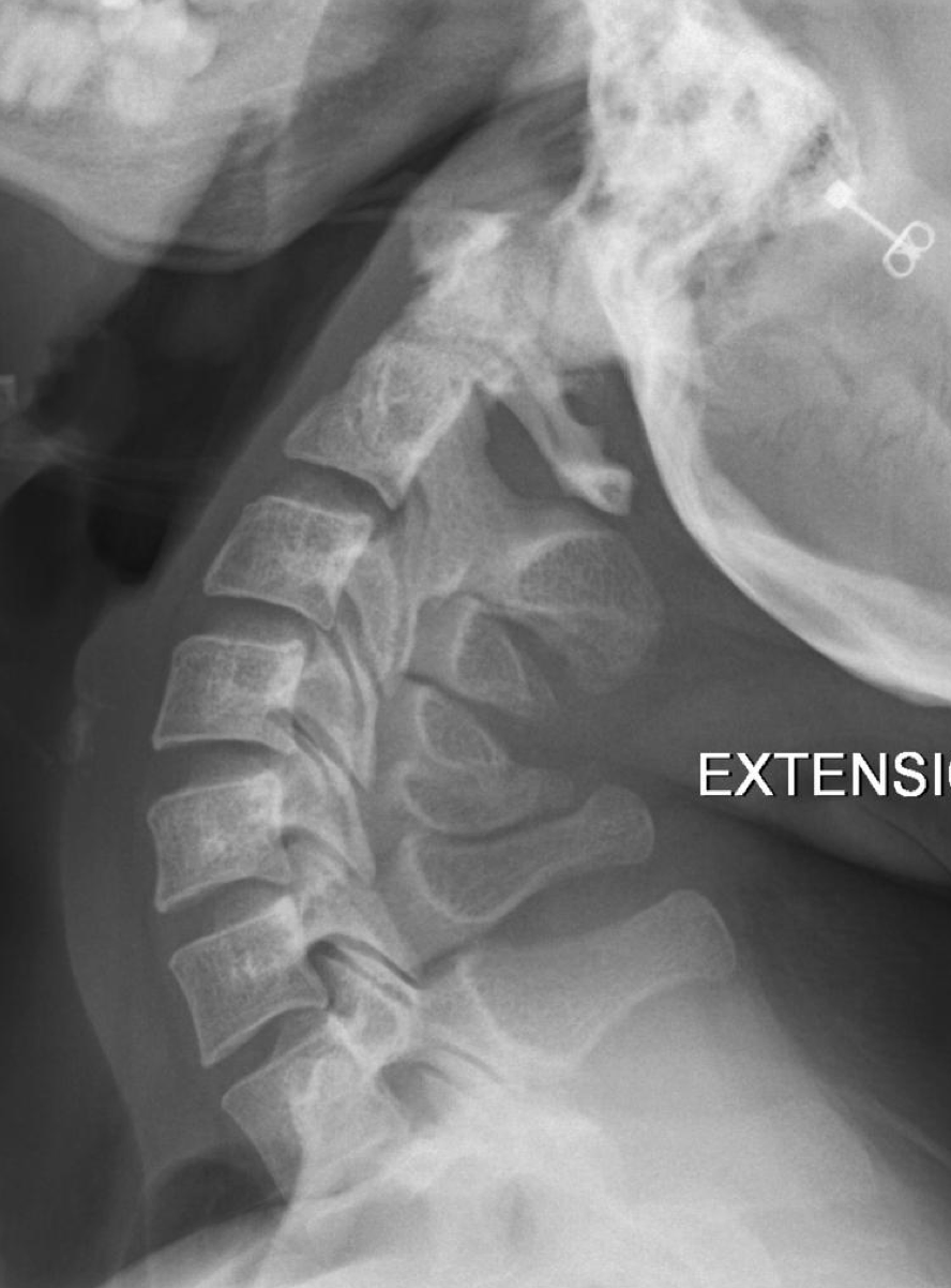 <p>What intersegmental motion should we see on a normal extension film</p>