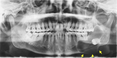 <p>T/F: The lesion in the left posterior mandible can be described as well-defined, radiolucent, corticated, unilocular lesion causing displacement of tooth 18 distally and inferiorly</p>