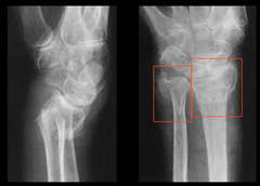 <p>intra-articular fracture of the radial styloid process</p>