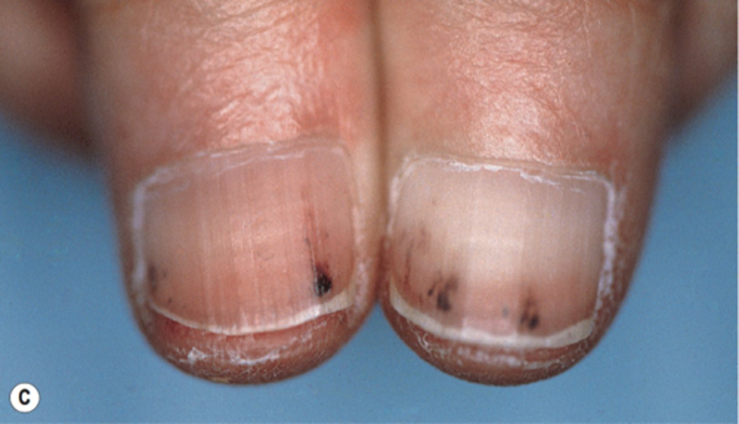 <p>endocarditis, damage to the nails</p>