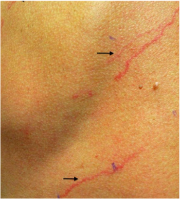 <p>____________________ infection classically presents with a <strong>Larva currens</strong> rash.</p>