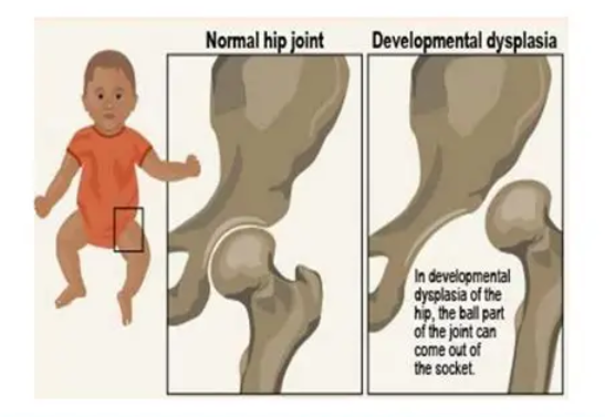 <ol><li><p><span style="color: rgb(182, 32, 198);"><strong>uneven skin folds</strong></span> of the <strong>thigh/butt</strong> folds</p></li><li><p><span style="color: rgb(70, 174, 195);"><strong>leg </strong></span><span style="color: rgb(7, 12, 13);">length </span><span style="color: rgb(70, 174, 195);"><strong>shorter </strong></span><span style="color: rgb(10, 15, 16);">and </span><span style="color: rgb(70, 174, 195);"><strong>knee height lower</strong></span></p></li><li><p>hip “<span style="color: rgb(226, 47, 47);"><strong>click</strong></span>” when moving (<strong>Ortolani/Barlow</strong> Test)</p></li></ol><p></p>