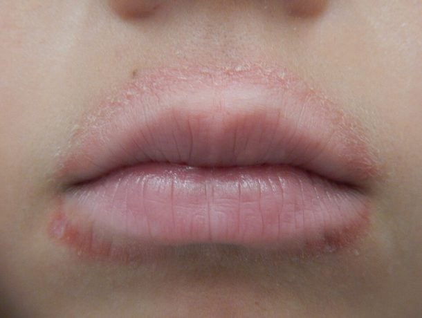 <p>Papulopustular plaques and scale around the mouth that spare the vermillion border</p><p>-Dx: clinical</p><p>-Tx: topical metronidazole</p>