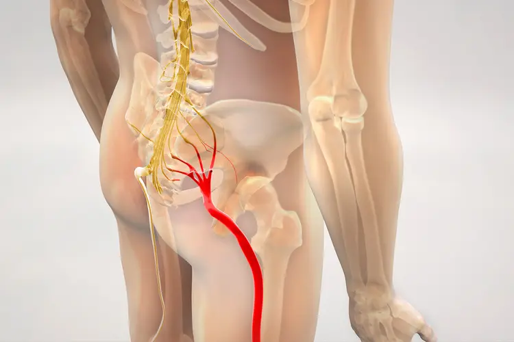 <p>Sciatica</p><ul><li><p>Common <strong>Lumbar Radculopathy</strong> - involving <strong>Sciatic Nerve </strong>causing <strong>Radiating Pain </strong>down <strong>Posterior Lower Limb</strong></p></li></ul><p></p>