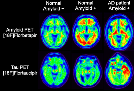 <p>neural activity but no information on structure, inject a position-emitting isotope (fluorodeoxyglucose) into artery which will react with electrons to cause gamma photons to be released and detected by a device. one benefit over fMRI: you can get isotopes that bind to particular receptors or metabolism of neurotransmitter</p><p>limitations: some temporal resolution 4-8s as MRI (less than EEG, MEG), lower spatial resolution, no anatomical —> needs to be combined with MRI or CT</p>