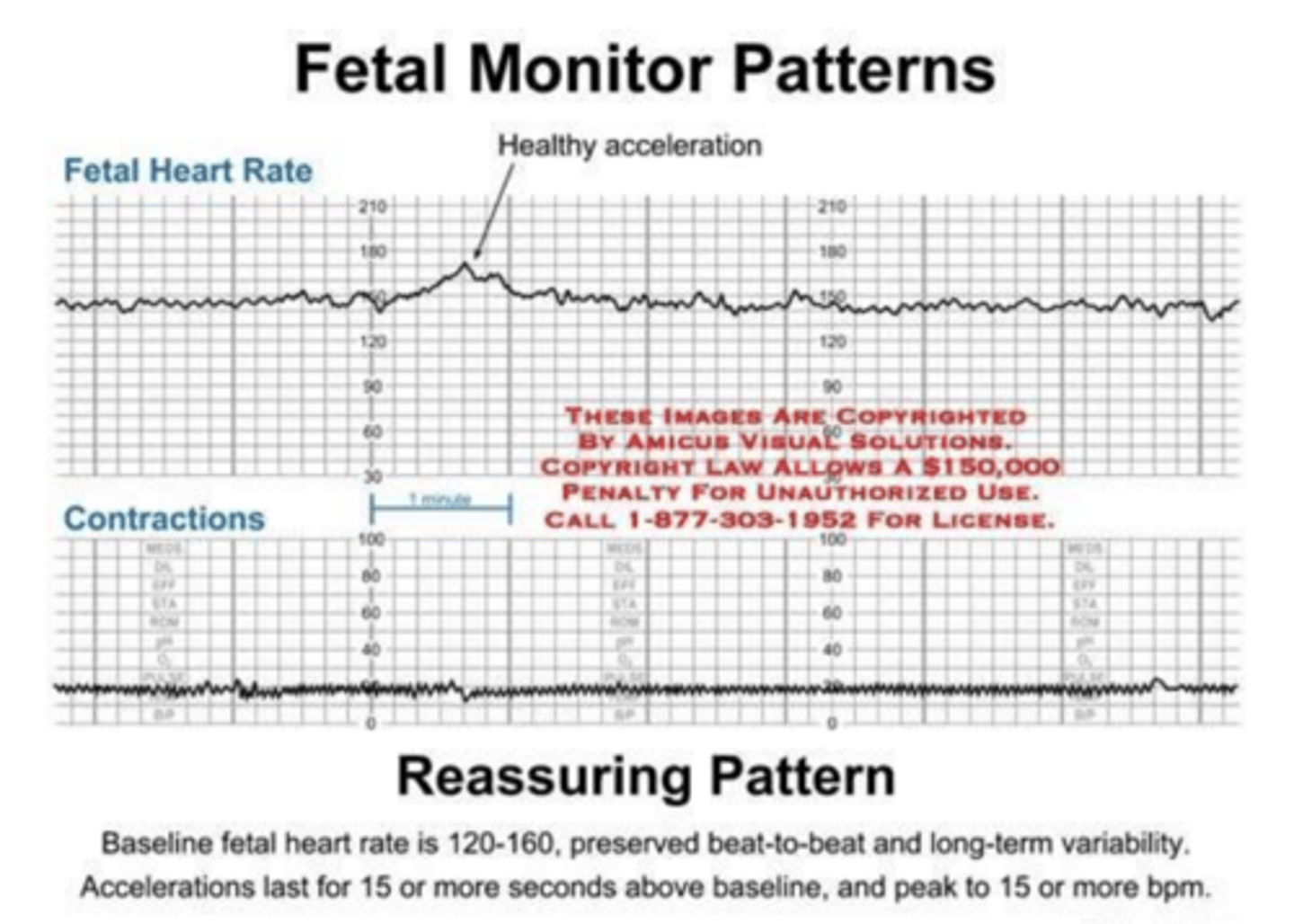 <p>- 15 beats/min lasting 15 seconds or longer > 32w</p><p>- 10 beats/min lasting 15 seconds or longer < 32w</p>