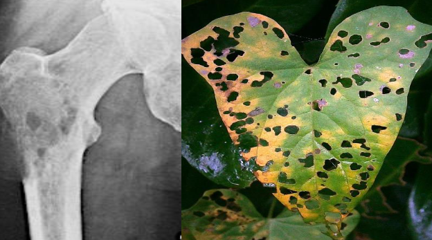<p>infection of the medullary bone with purulence</p><ul><li><p>causes:</p><ul><li><p>bacteremia</p></li><li><p>extension of periapical abscess</p></li><li><p><span style="color: red;">osteoradionecrosis (ORN)</span> or <span style="color: red;">medication-related osteonecrosis of the jaw (MRONJ)</span></p></li><li><p>physical injury:</p><ul><li><p>fracture, surgery</p></li></ul></li></ul></li><li><p><strong>clinical findings:</strong></p><ul><li><p><span style="color: red;">pain</span> → primary feature</p></li><li><p><span style="color: red;">lower lip paresthesia</span></p></li><li><p><span style="color: red;">lymphadenopathy</span></p></li></ul></li><li><p><strong>radiographic findings:</strong></p><ul><li><p><span style="color: red;">moth-eaten appearance</span></p></li><li><p><span style="color: red;">not visible</span> unless approximately <span style="color: red;">60%</span> of the bone is demineralized</p></li></ul></li><li><p><strong>tx:</strong></p><ul><li><p><span style="color: red;">debridement of necrotic bone</span></p></li><li><p><span style="color: red;">aggressive antibiotic therapy</span></p></li><li><p><span style="color: red;">drainage of pus</span></p></li></ul></li></ul><p></p>