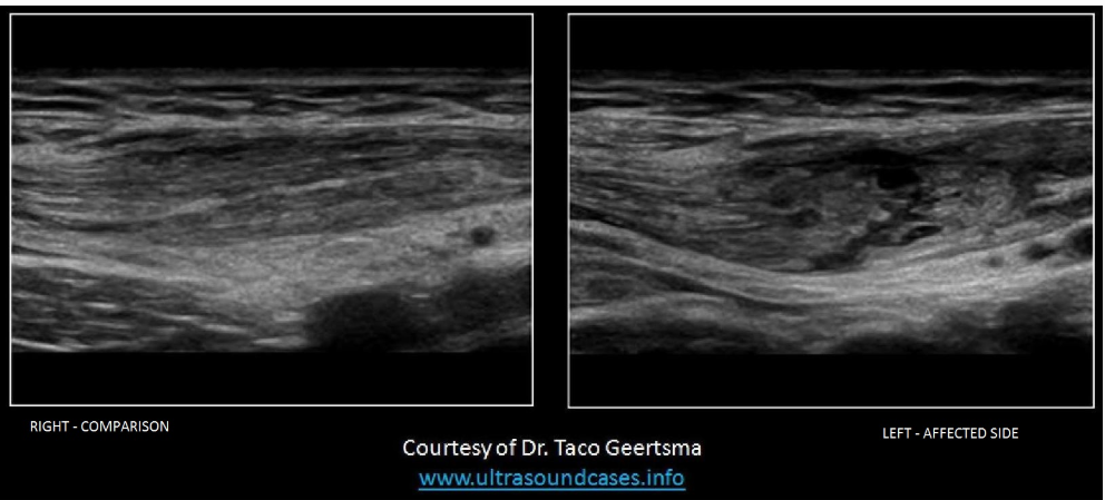 <p>The image demonstrates a transverse view of the right and left side of the abdominal wall, about 5cm lateral to the umbilicus. Which of the following statements is true regarding the findings on the image?</p><p>A. There is a heterogeneous, rounded mass located within the left rectus sheath, within the muscle layers and anterior to the peritoneal lining.</p><p class="p1">B. There is a homogeneous, rounded mass located within the left rectus sheath, anterior to the muscle layers and the peritoneal lining.</p><p class="p1">C. There is a heterogeneous, rounded mass located within the muscle layers and posterior to the peritoneal lining on the left side.</p><p class="p1">D. The image demonstrates the normal appearance of the muscle structures of the anterior abdominal wall bilaterally.</p>
