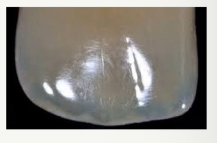 <p>Material appears to be one colour when light reflected from it, another when light transmitted through it- transilluminates reds and scatters blue within- so appears blueish </p><p>Enamel opalescent effects brighten tooth- give optical depth and vitality </p>