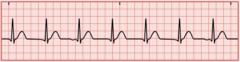 <p>Same as the escape rhythm, but the heart rate is 100 to 150/min</p>