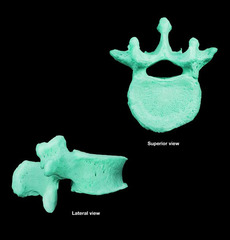 <p>disarticulated</p>