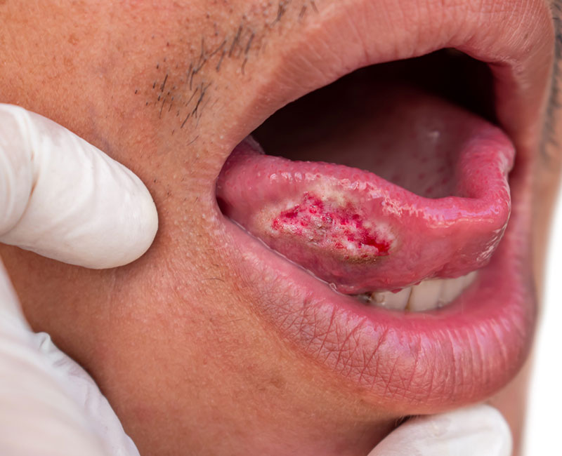 <ul><li><p><span style="background-color: transparent; font-family: "Times New Roman", serif;">Mouth cancer – tongue</span></p></li><li><p><span style="background-color: transparent; font-family: "Times New Roman", serif;">Non-healing ulcer > 2 weeks</span></p></li><li><p><span style="background-color: transparent; font-family: "Times New Roman", serif;">Check lymph nodes and skin – hard, raised edges, bleed easily.</span></p></li></ul><p></p>