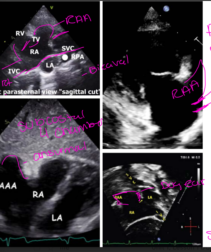 <p>1st view is RVIF view </p><p>Bicaval </p><p>subcostal 4 chamber </p><p>subcostal bicaval view (both vena cava attached to the RA)</p>