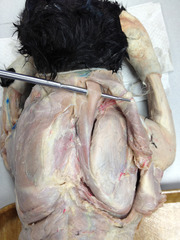 <p>muscle that serves to draw the scapula forward and toward the mid-dorsal line</p>